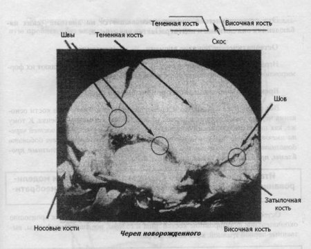 Остеопатия для новорожденных. Почему необходимо остеопатическое вмешательство?